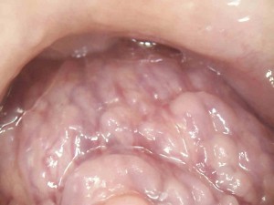 Lingual Tonsil A
