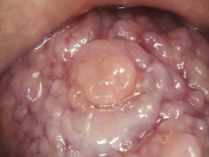 Lingual Tonsil C