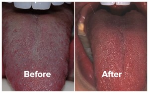 Tongue photos of bad breath patient, before and after treatment