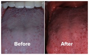 Halitosis patient tongue photos, before and after treatmeent