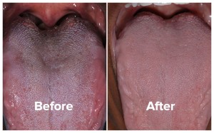 Halitosis patient tongue photos before and after treatment.
