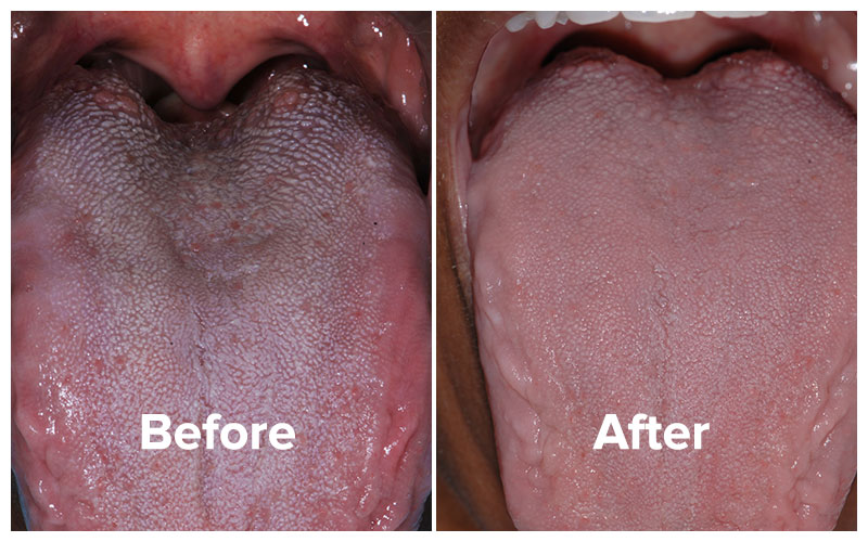 patient Laverne's before and after tongue photos