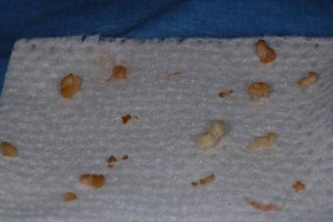 An accumulation of tonsil stones removed from a patient's tonsils