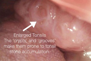A patient's enlarged tonsils after removal of tonsil stones