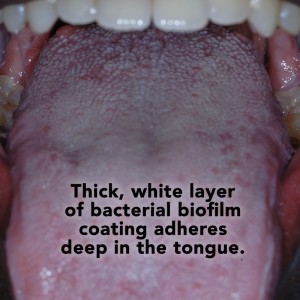 biofilm-tongue-coating