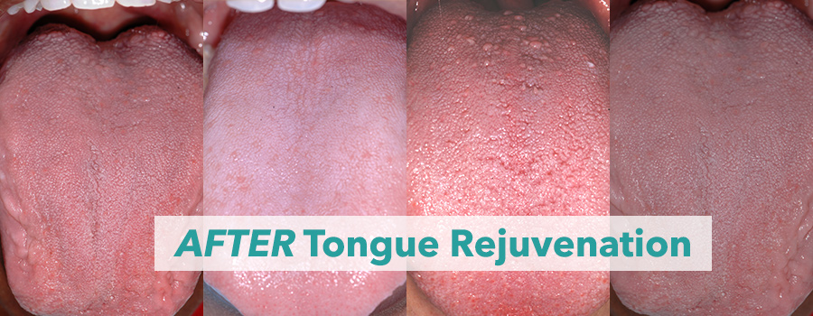 after-tongue-rejuvenation