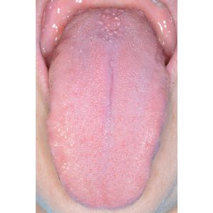 Tongue After