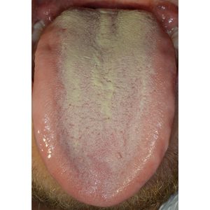 Tongue Before