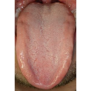 Tongue After